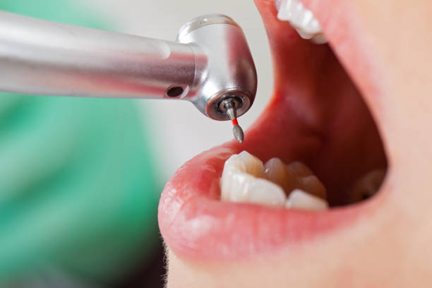 Best Emergency Dental Care for Broken or Chipped Teeth in Clare, MI